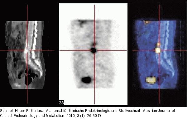Ossäre Metastase