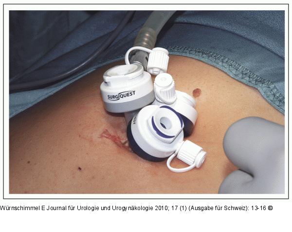 Single-Incision Laparoscopic Surgery