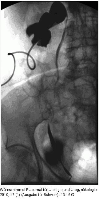 Single-Incision Laparoscopic Surgery
