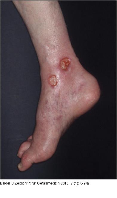 Ulcus cruris arteriosum