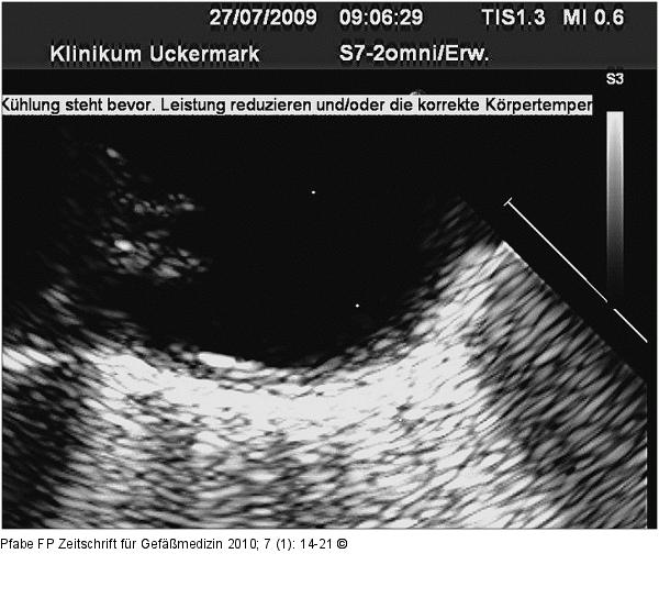 Aorta thoracalis