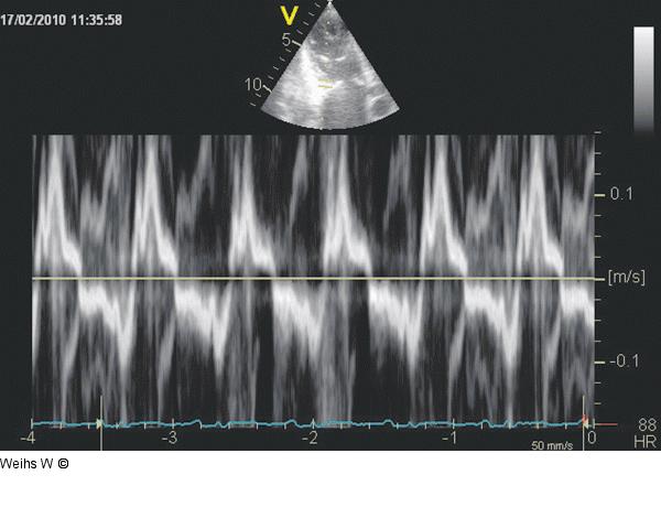 Tissue Doppler
