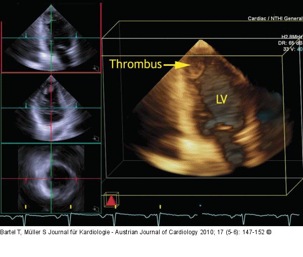 Thrombus