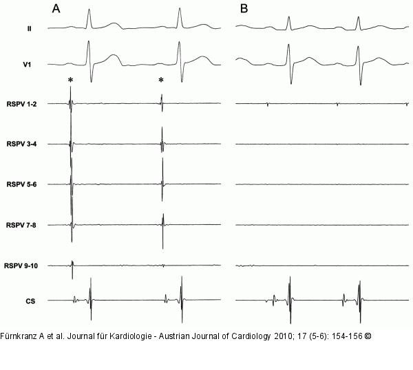 EKG-Ableitungen