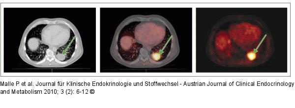 Pulmonale Metastase