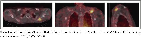 Ossäre Metastase