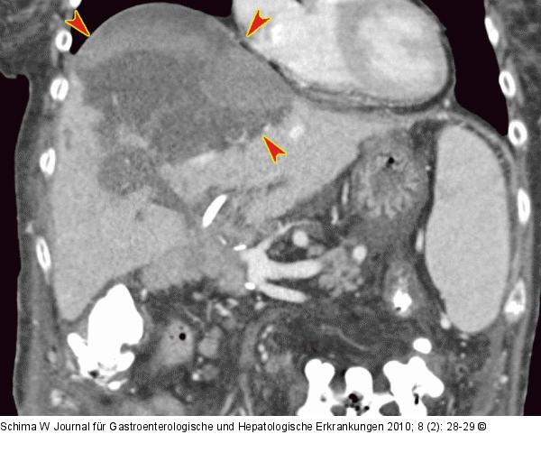 MDCT - PTCD