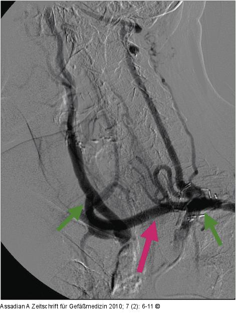 Angiographie