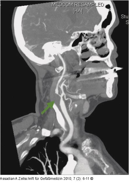 CT-Angiographie