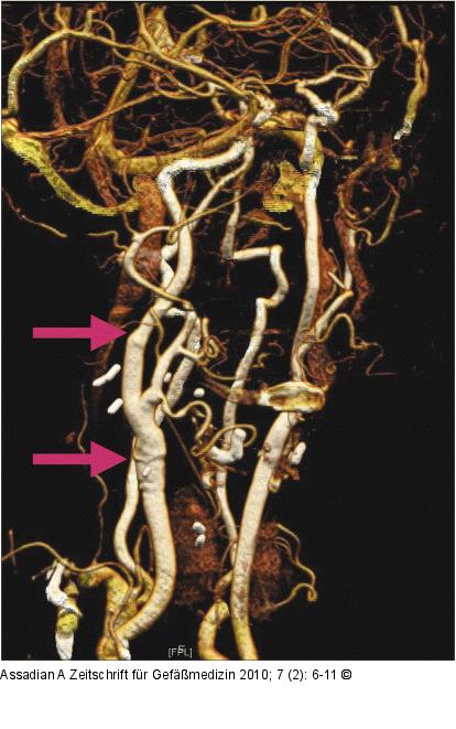 CT-Angiographie