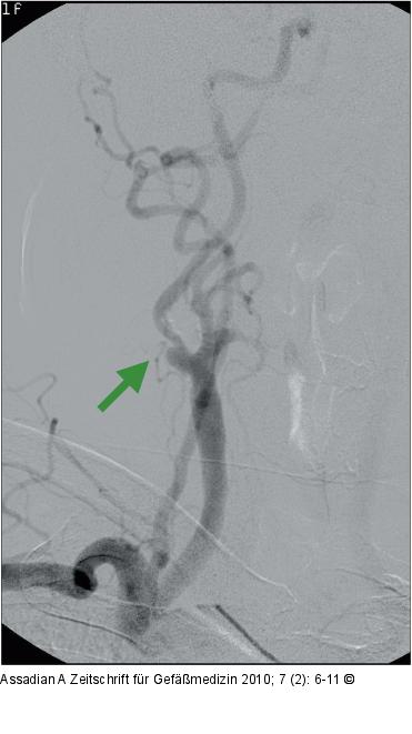 Subtraktionsangiographie