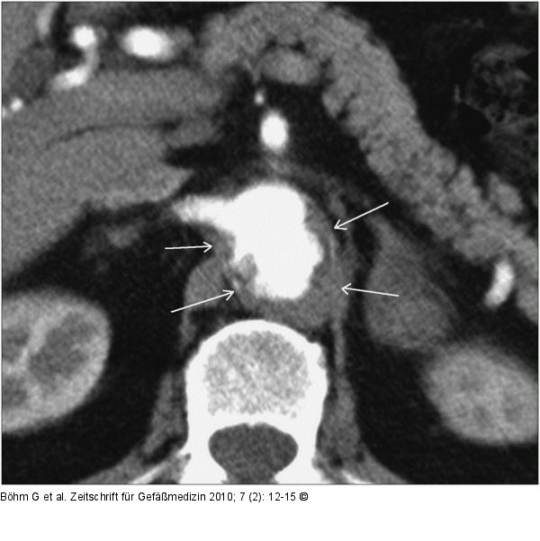 Aorta