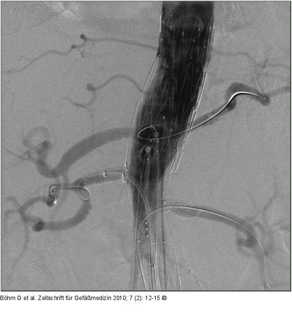 Angiogramm