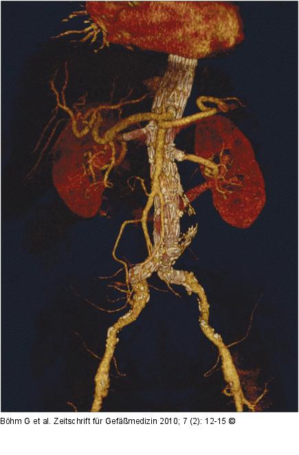 CT - 3D-Rekonstruktion