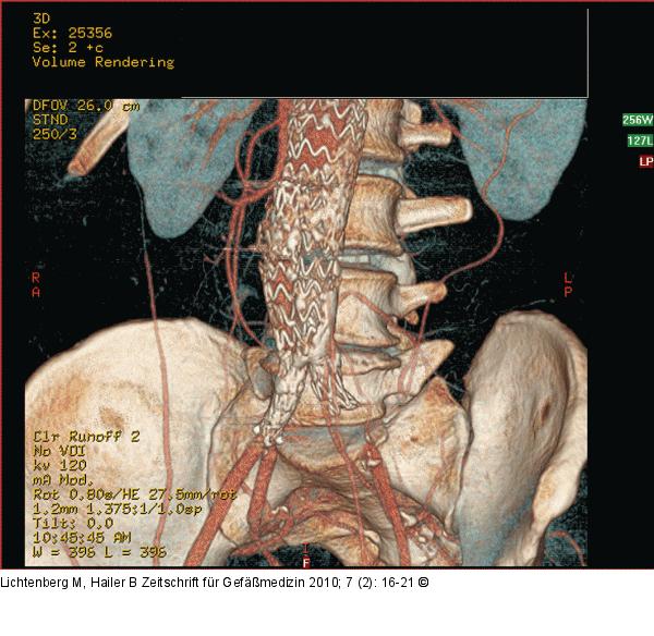 Aortenstentgraft