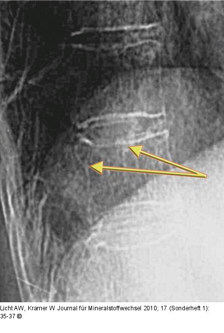 TH11