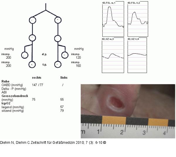 Arterielle Ausmessung - Klinische Präsentation