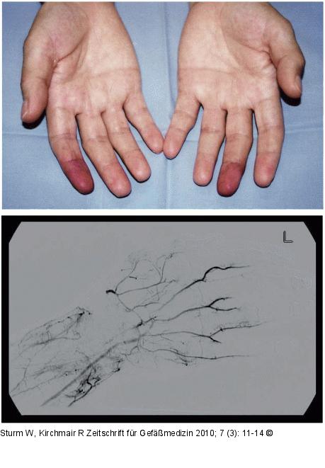 Raynaud-Phänomen
