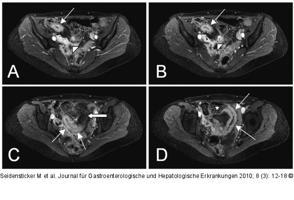 Morbus Crohn