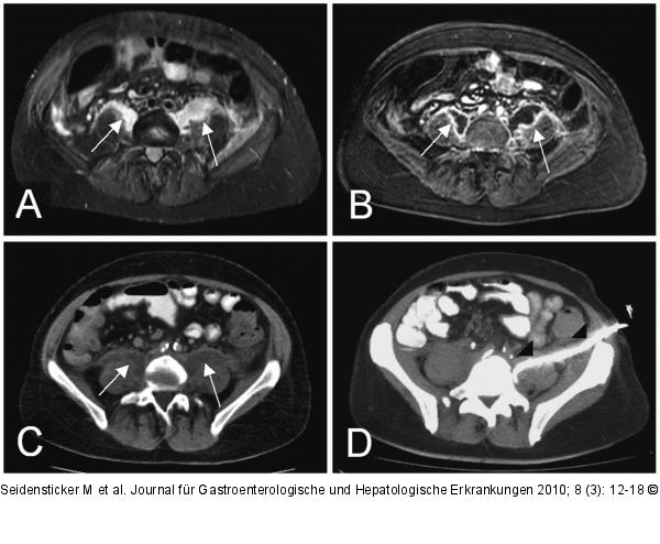 Morbus Crohn