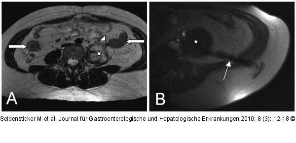 Morbus Crohn