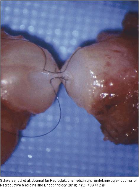 Vasovasostomie