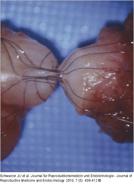 Vasovasostomie