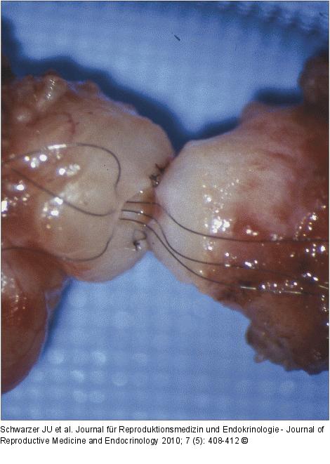 Vasovasostomie
