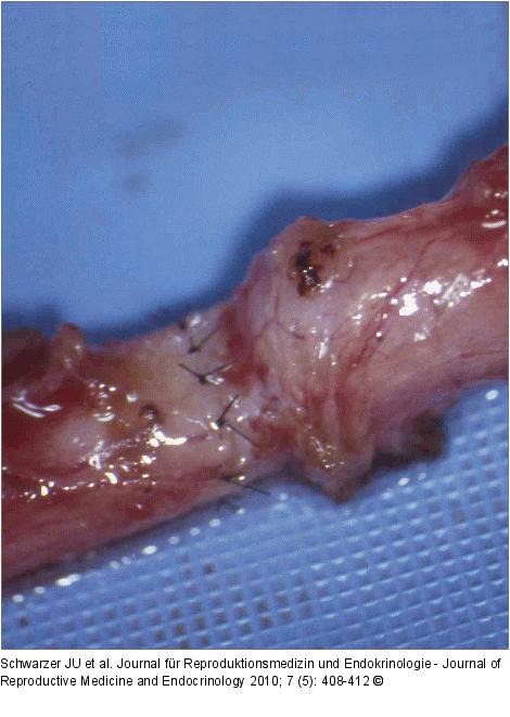 Vasovasostomie