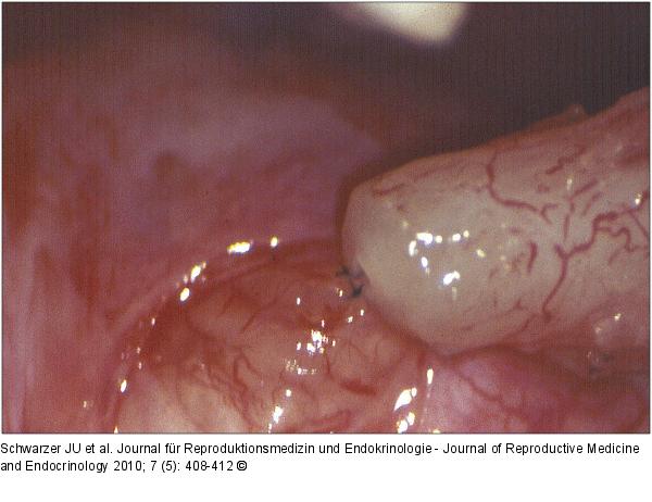 Tubulovasostomie