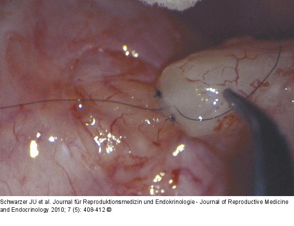 Tubulovasostomie