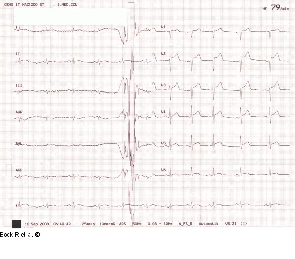 EKG