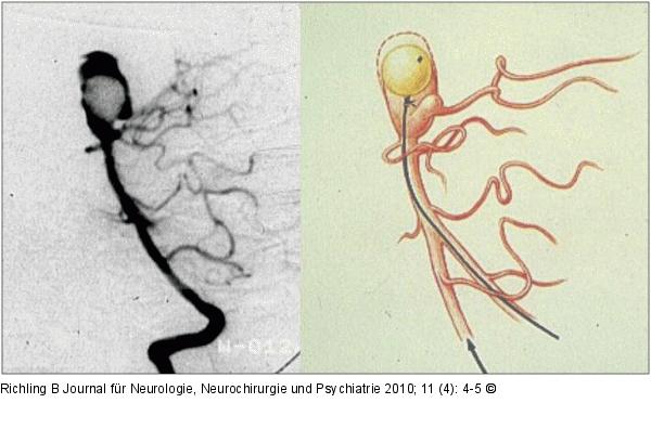 Aneurysma