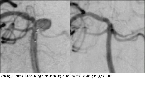 Aneurysma