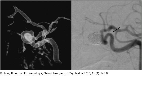 Aneurysma