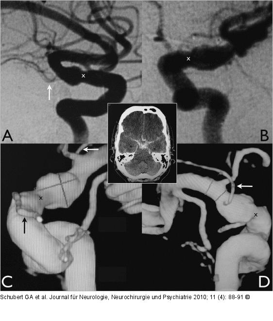 Arteria carotis - Aneurysma