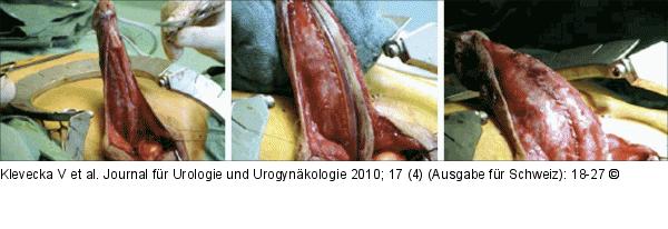 Harnröhrenstriktur