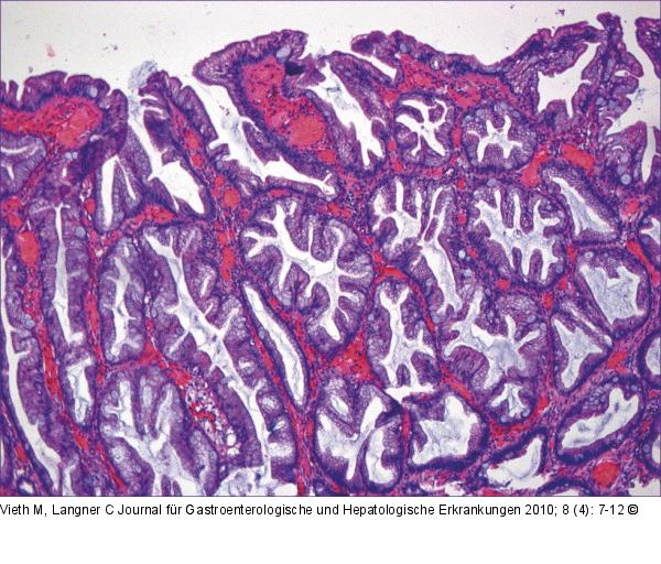 Polyp