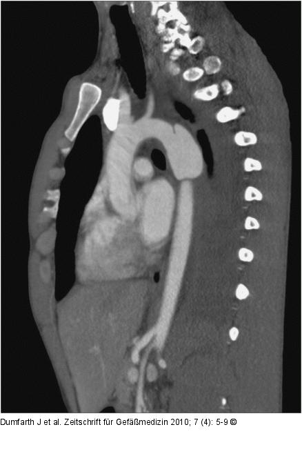 Aortenisthmus