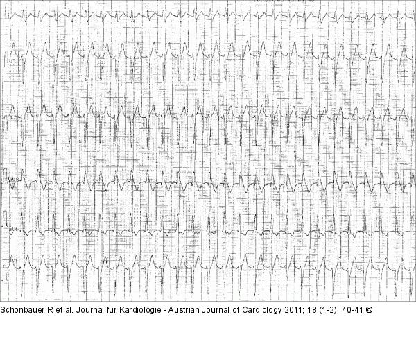 EKG