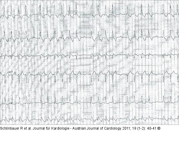 EKG