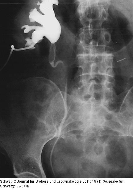 Nephrostomie