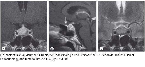 Lymphozytäre Adenohypophysitis