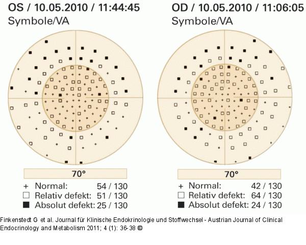 Lymphozytäre Adenohypophysitis