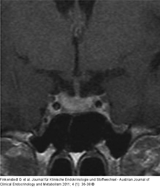 Lymphozytäre Adenohypophysitis