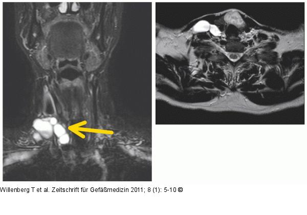 MR Malformation