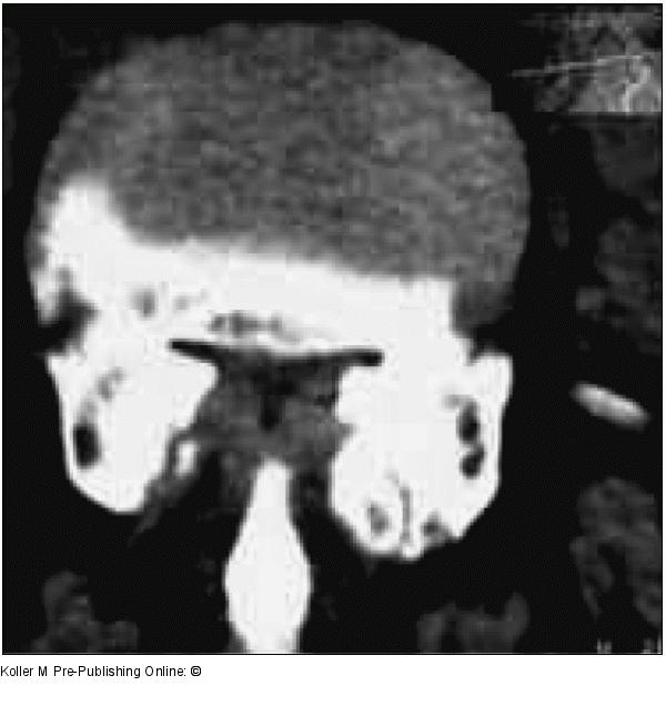 Spinalkanalstenose