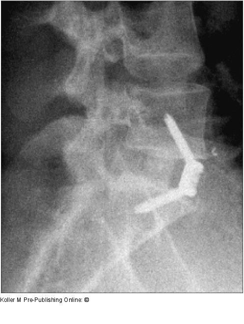 Spondylodese