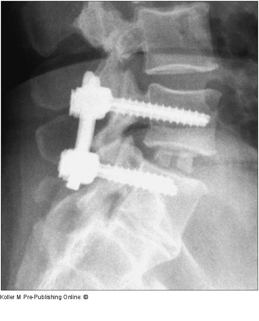 Spondylodese