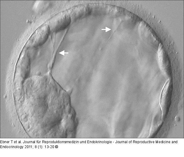 Blastocyst